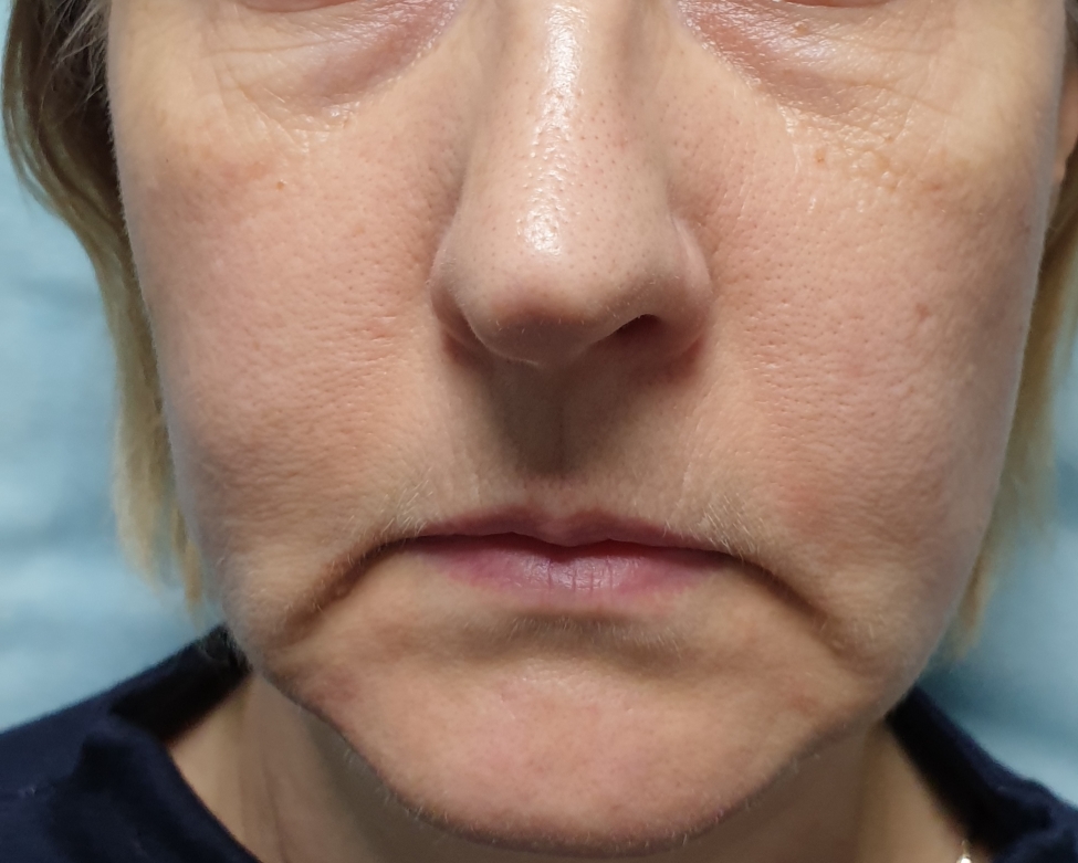Инъекции гиалуроновой кислоты для лица фото до и после